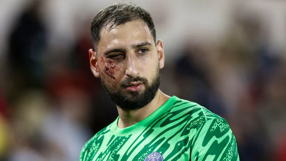10 agrafes et un traumatisme facial. Donnarumma défiguré par une horrible semelle, le PSG crie au scandale