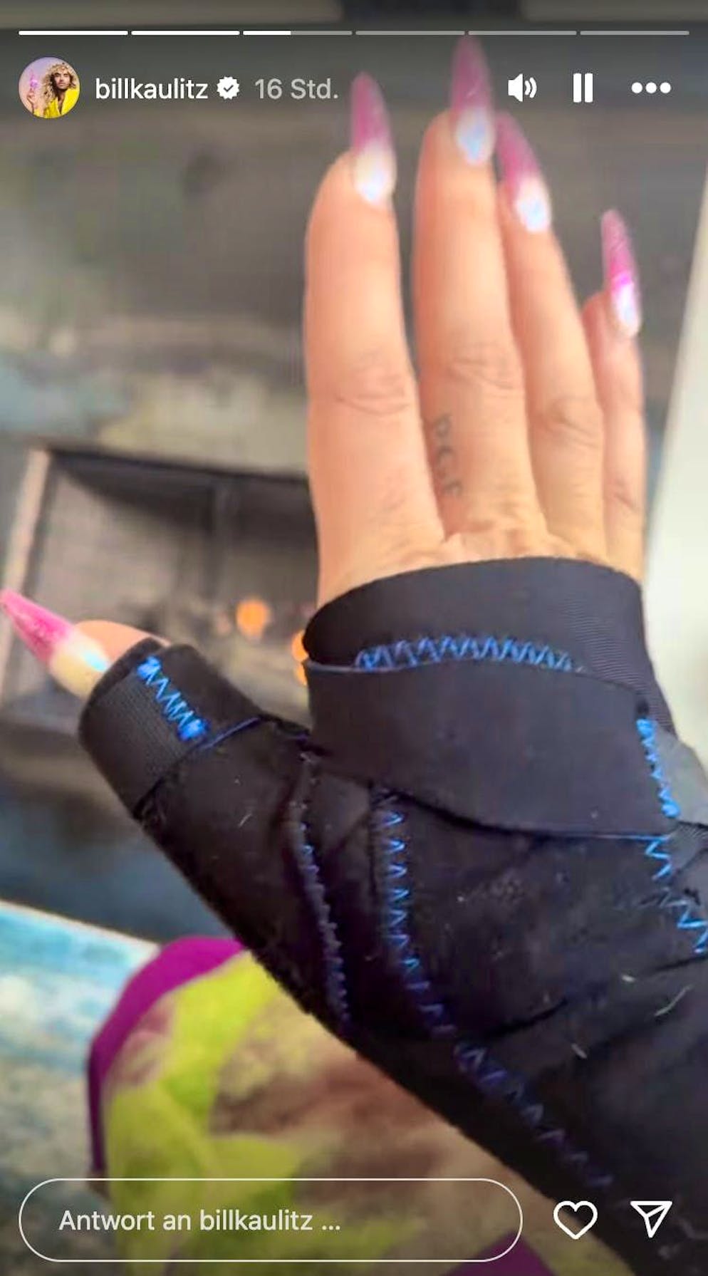 Bill Kaulitz injured himself while skiing and revealed on Instagram that he had torn a capsule in his thumb.