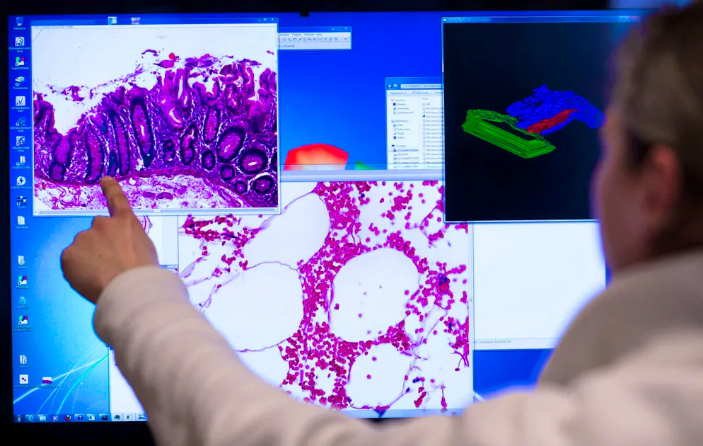 Study: Milk consumption can reduce the risk of bowel cancer - Gallery. Colon cancer is the third most common tumor disease in Germany. (archive picture)