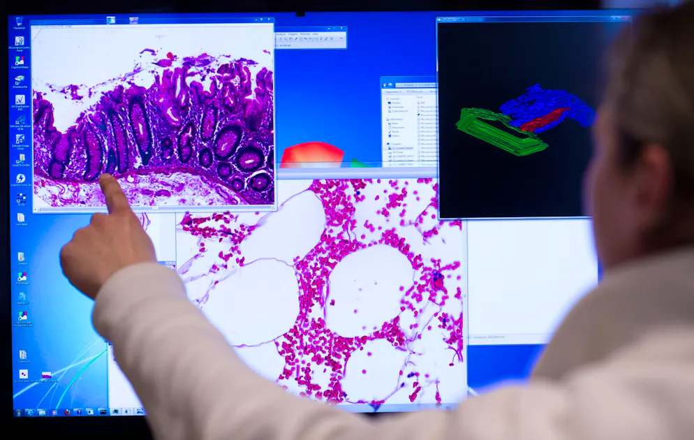 Studie: Milchkonsum kann das Risiko für Darmkrebs vermindern - Gallery. Darmkrebs ist die dritthäufigste Tumorerkrankung in Deutschland. (Archivbild)