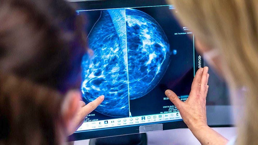 The study on the use of artificial intelligence in the detection of breast cancer is the largest on the subject worldwide to date. (archive image)
