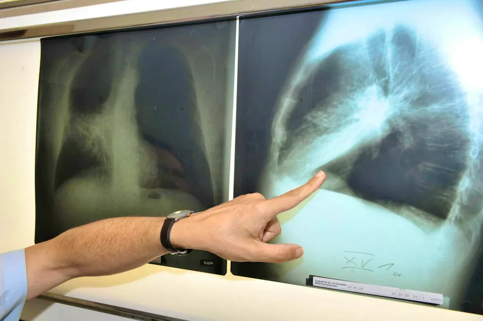 In 2022, lung cancer was the deadliest type of cancer worldwide with around 1.82 million deaths. (archive image)