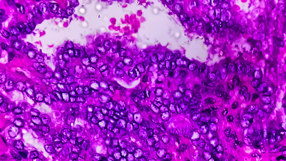 Microscopic image of a thyroid carcinoma. With the new X-ray technology, tumors do not have to be cut into thin slices for imaging diagnosis. (symbolic image)