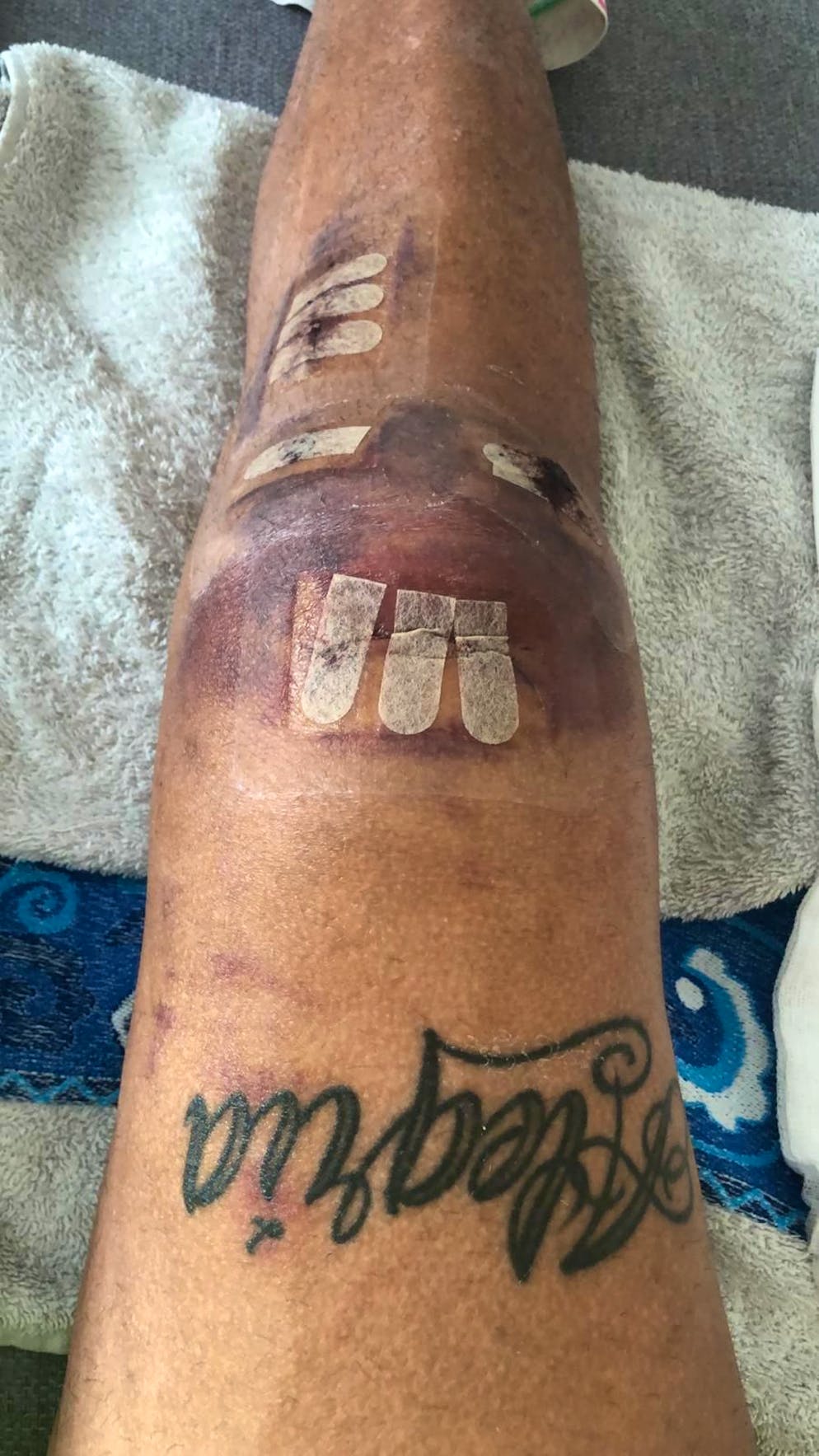 Das Knie von Miguel Peralta nach einer seiner vielen Operationen.