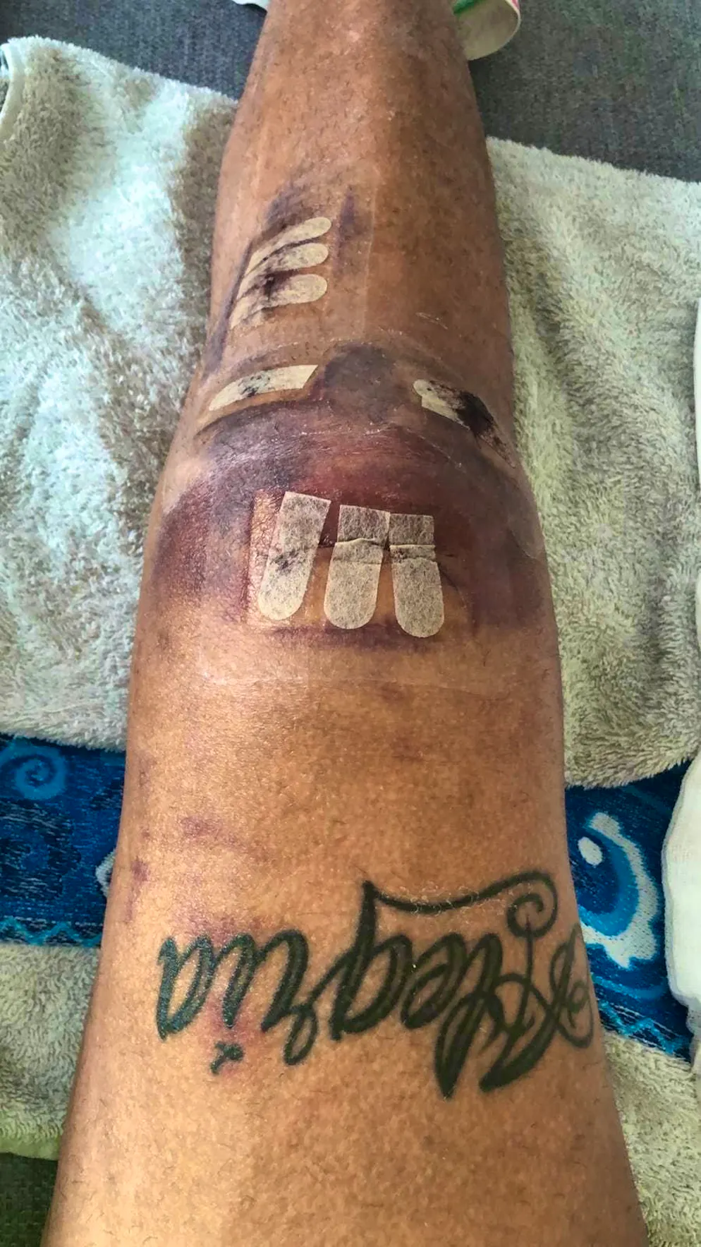 Miguel Peralta's knee after one of his many operations.