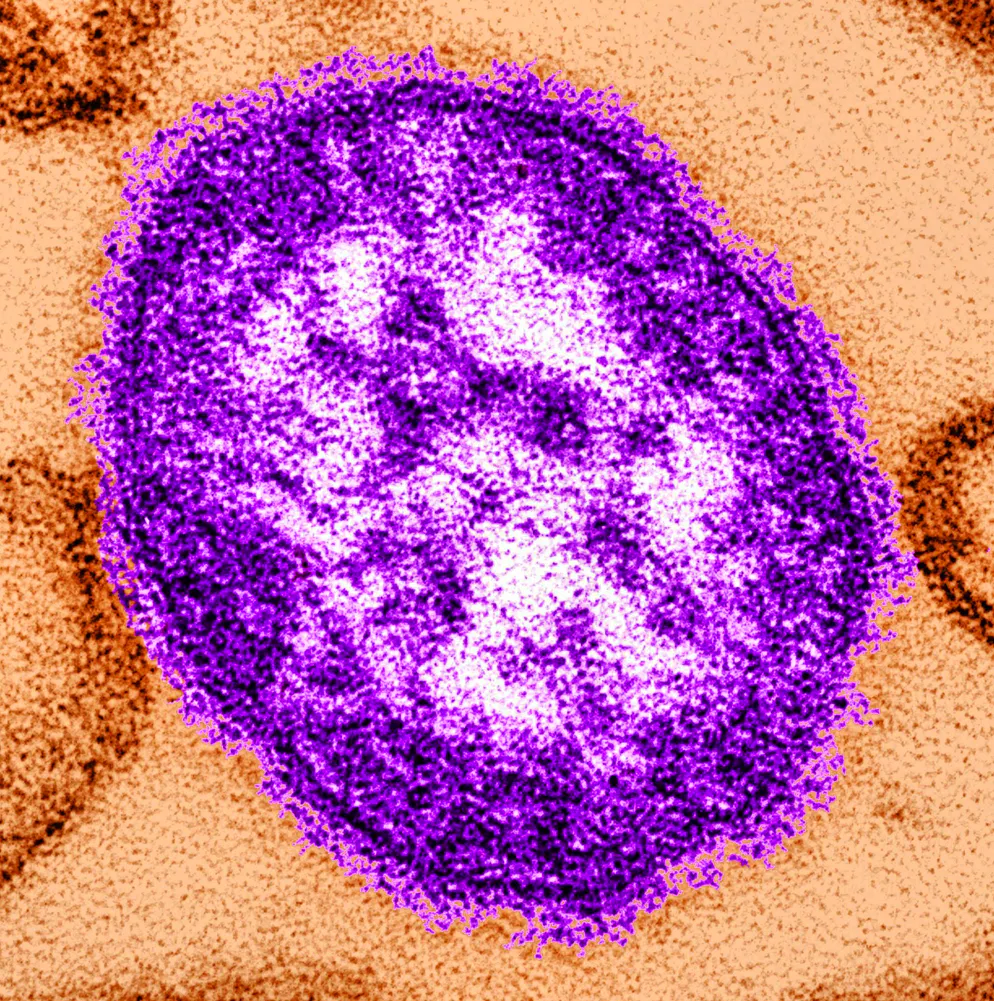 Second child dies after measles outbreak in the USA - Gallery. The USA is currently struggling with a measles outbreak - especially the state of Texas. (archive image)