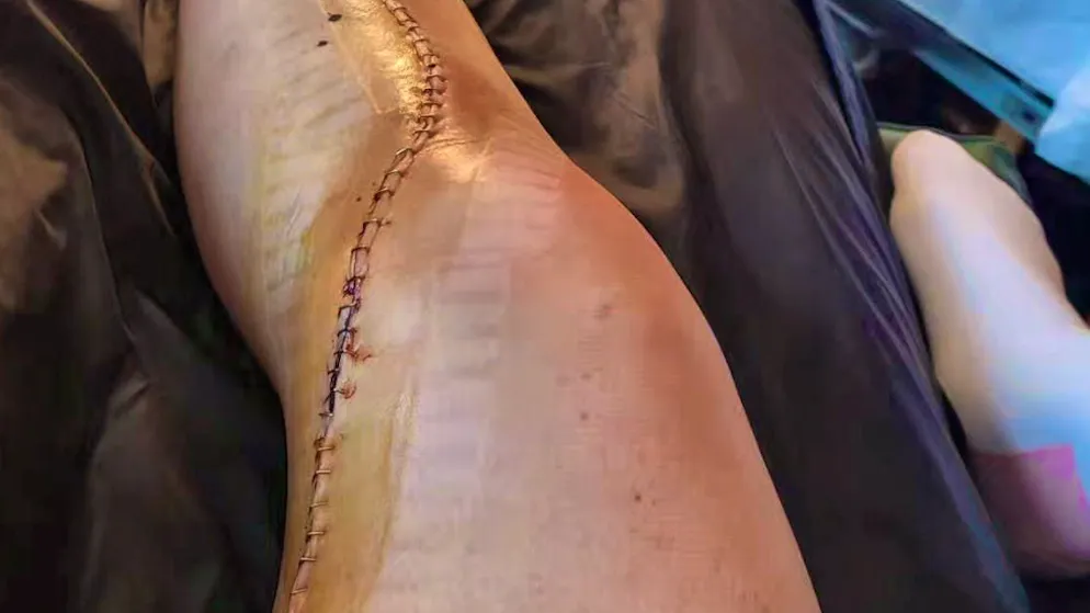 Brignone shows her damaged leg.