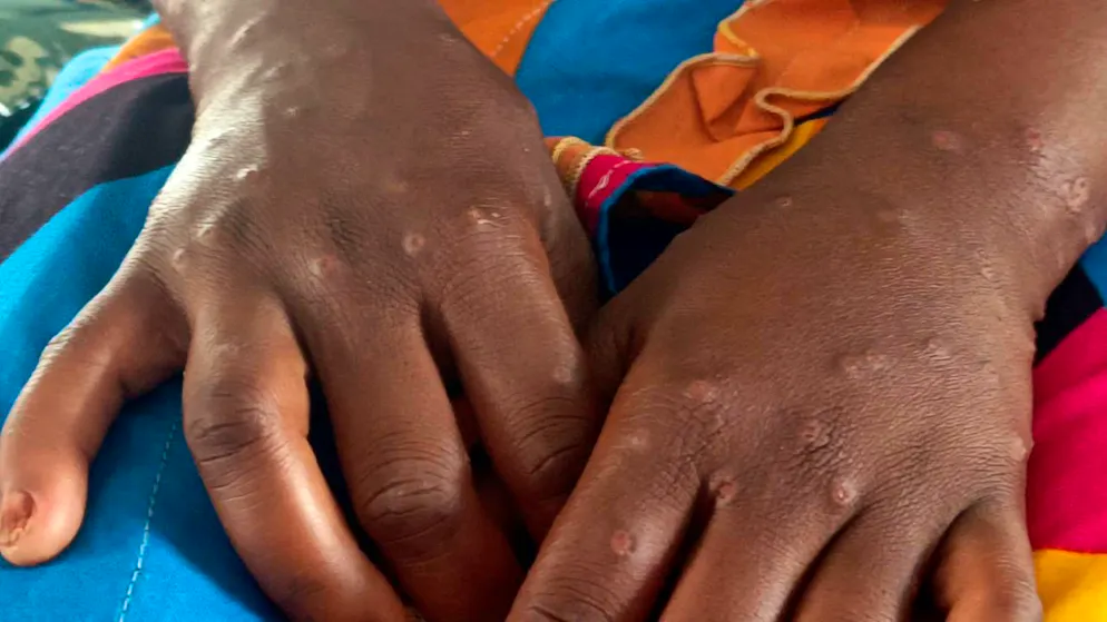 Politique. Plus de 1100 cas de mpox recensés et 9 décès en Sierra Leone