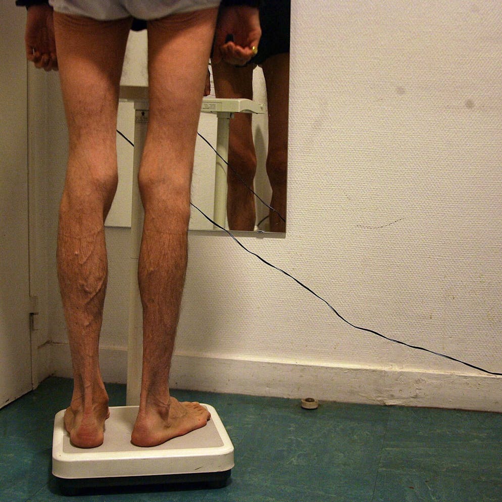 Anorexie, boulimie.... Quelles pathologies derrière les troubles alimentaires ?