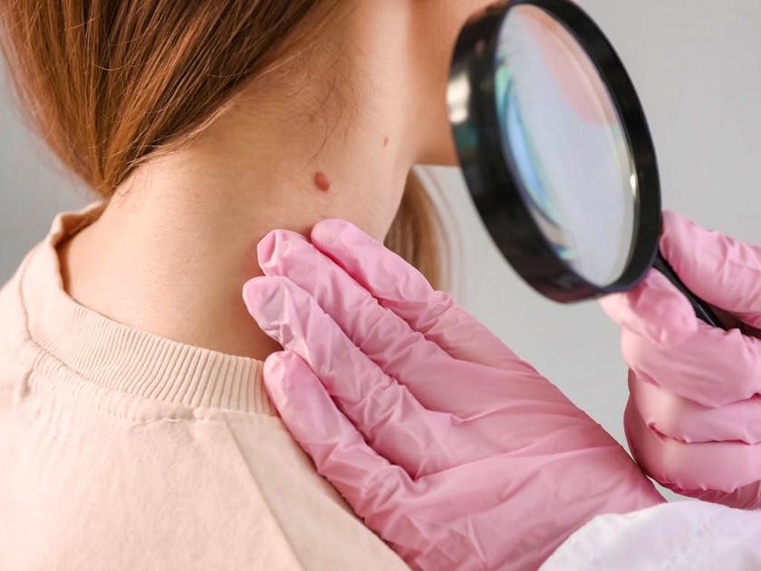 Melanoma: Come Riconoscere i Primi Segnali e Proteggere la Tua Pelle - Guida dell'Esperto
