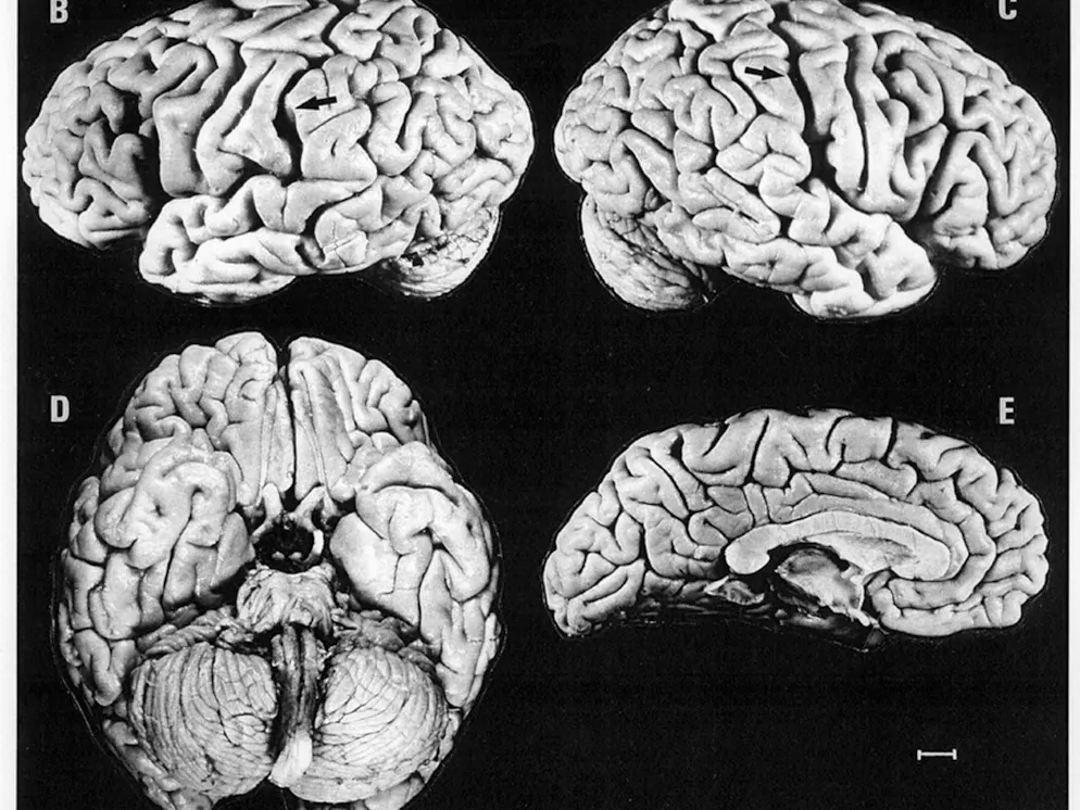 Albert Einstein's brain was cut into 240 pieces for research purposes. Only recently has it been known that his brain was not ordinary. Certain parts were much more pronounced than in an average person.