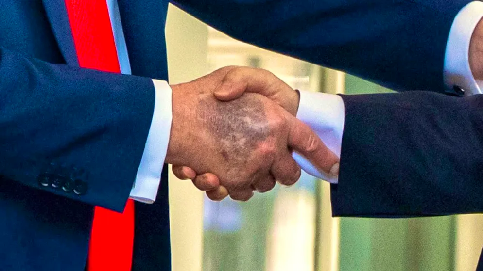 The bruises on Trump's hands caused speculation. According to his doctor, they were caused by frequent handshakes.
