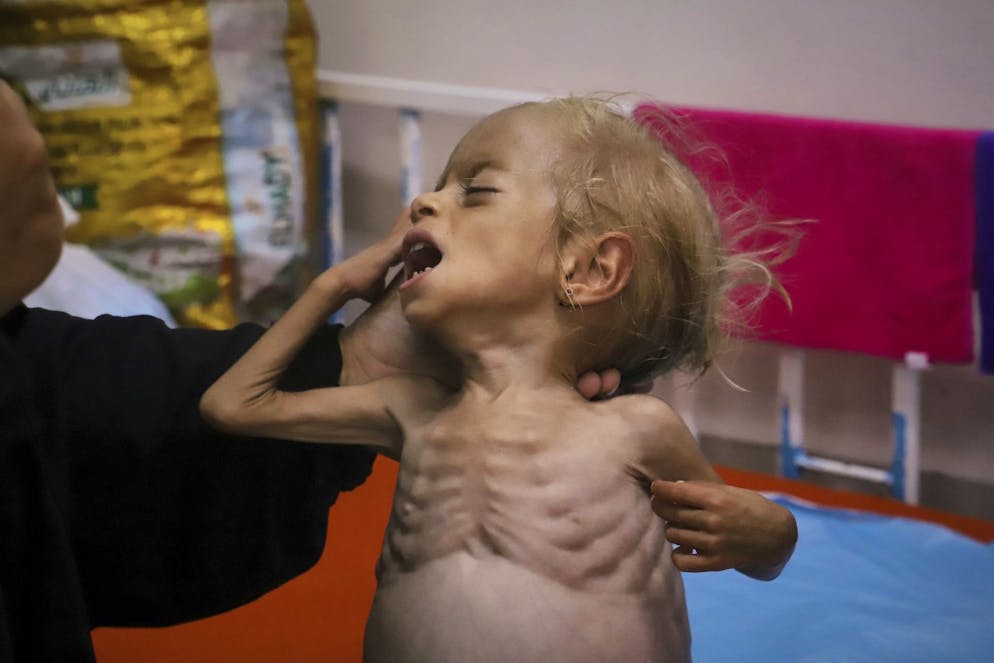 Islam Qudeih montre sa fille Shamm, âgée de 2 ans, souffrant de malnutrition sévère et torse nu, aux journalistes à l'hôpital Nasser de Khan Younis, dans le sud de la bande de Gaza, le samedi 9 août 2025. Les médecins ont déclaré que Shamm souffrait peut-être d'une maladie génétique affectant le développement musculaire et osseux, mais qu'il n'existait aucun moyen de la dépister à Gaza. Le mardi 12 août, sa famille a obtenu l'autorisation de se rendre dans un hôpital en Italie. (AP Photo/Mariam Dagga)