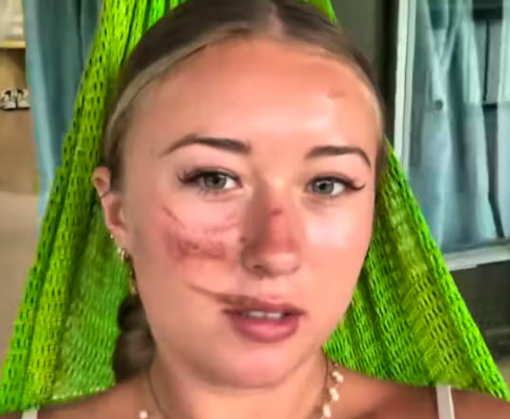 Die Britin könnte für den Rest ihres Lebens Wunden haben. 