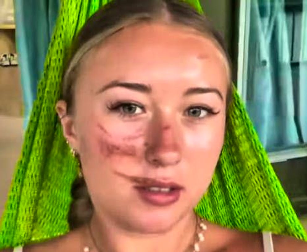 La Britannique pourrait avoir des blessures pour le reste de sa vie.