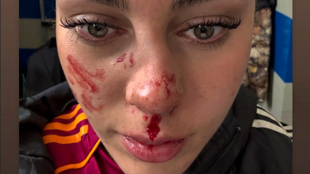 Ouch! That hurts .... Nati star Alayah Pilgrim breaks her nose and is sidelined