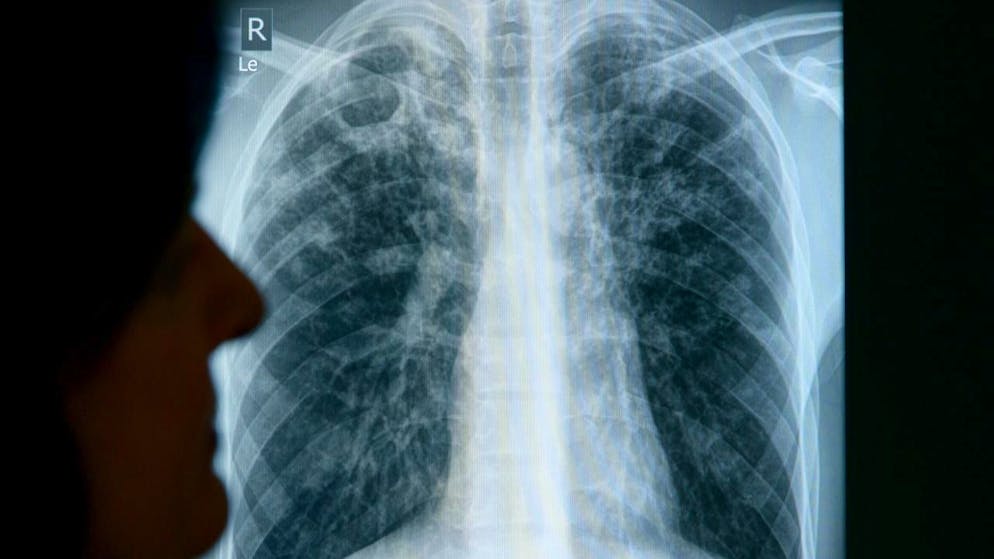 Salute. I casi di tubercolosi sono in aumento in Svizzera, ecco perché