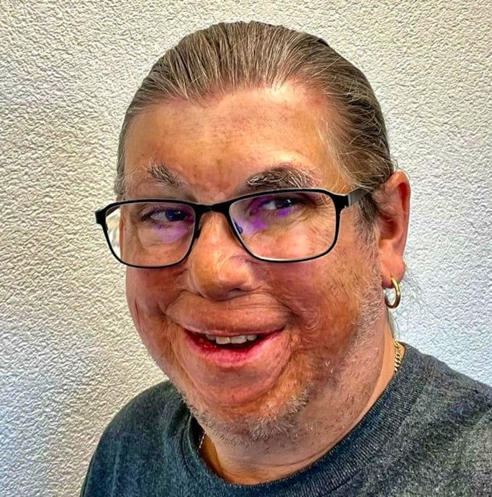 Martin Achermann lebt seit fast 30 Jahren mit den Folgen schwerer Brandverletzungen – und hat seinen Weg gefunden.