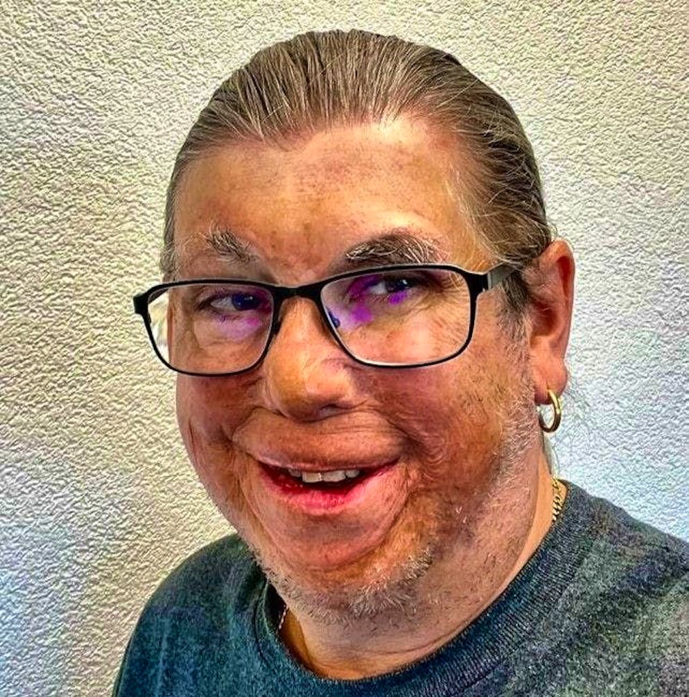 Martin Achermann has been living with the consequences of severe burn injuries for almost 30 years - and has found his way.