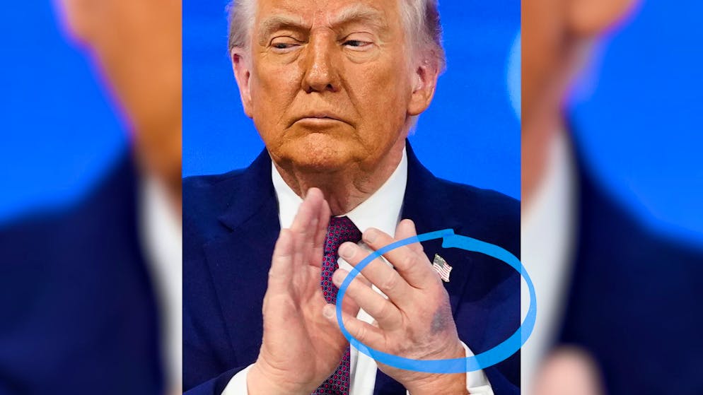 US President explains why. Stain on his hand causes a stir during Trump's WEF appearance