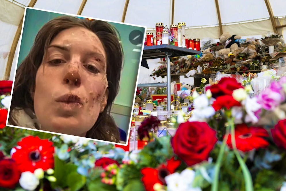 Eleonora Palmieri shows her burns. 