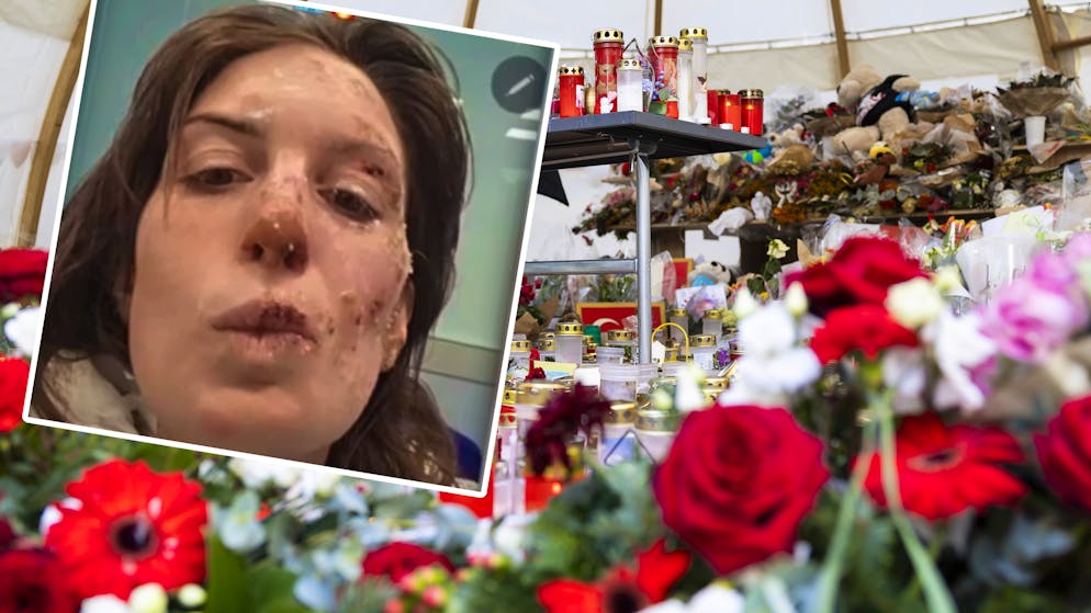 Tre settimane dopo il disastro. Una sopravvissuta all'inferno di Crans-Montana mostra le ustioni