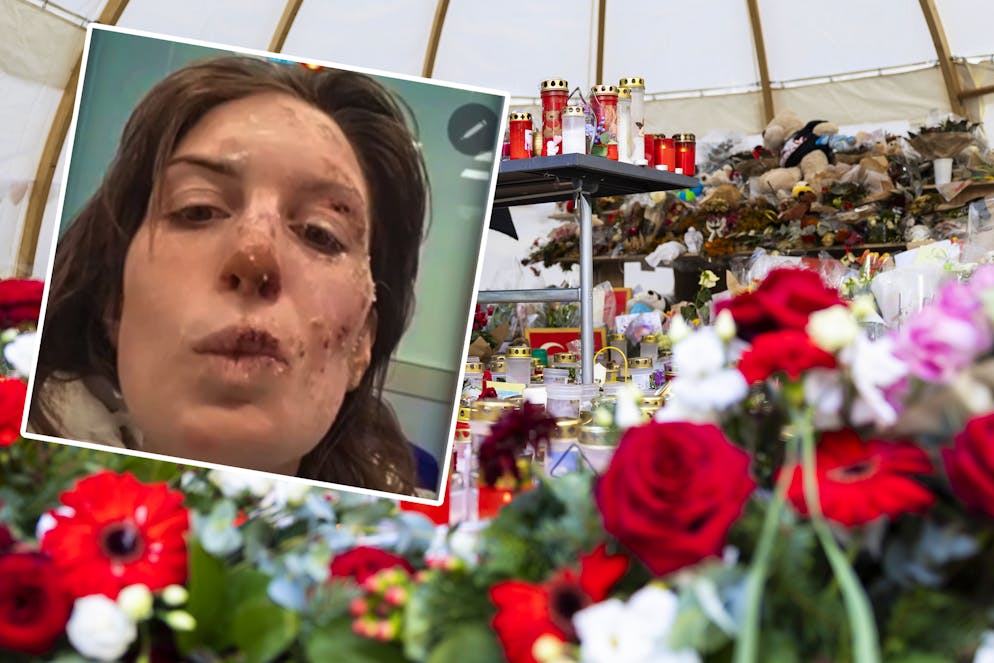 Eleonora Palmieri zeigt ihre Brandwunden. 