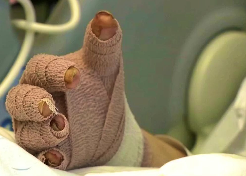 Rose brauchte mehrere Hauttransplantationen. 