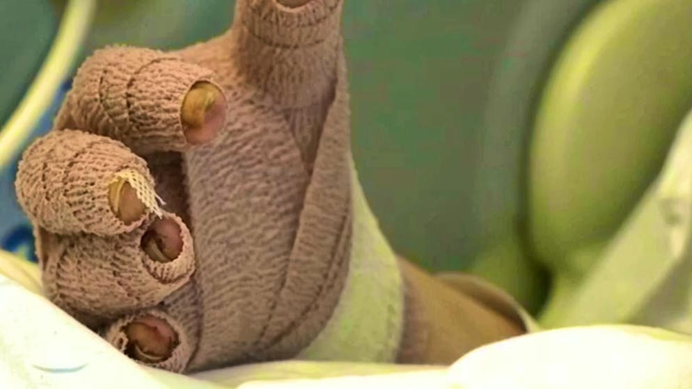 Incendio di Capodanno. Una vittima di Crans-Montana: «Non sarò mai più in grado di condurre una vita normale»