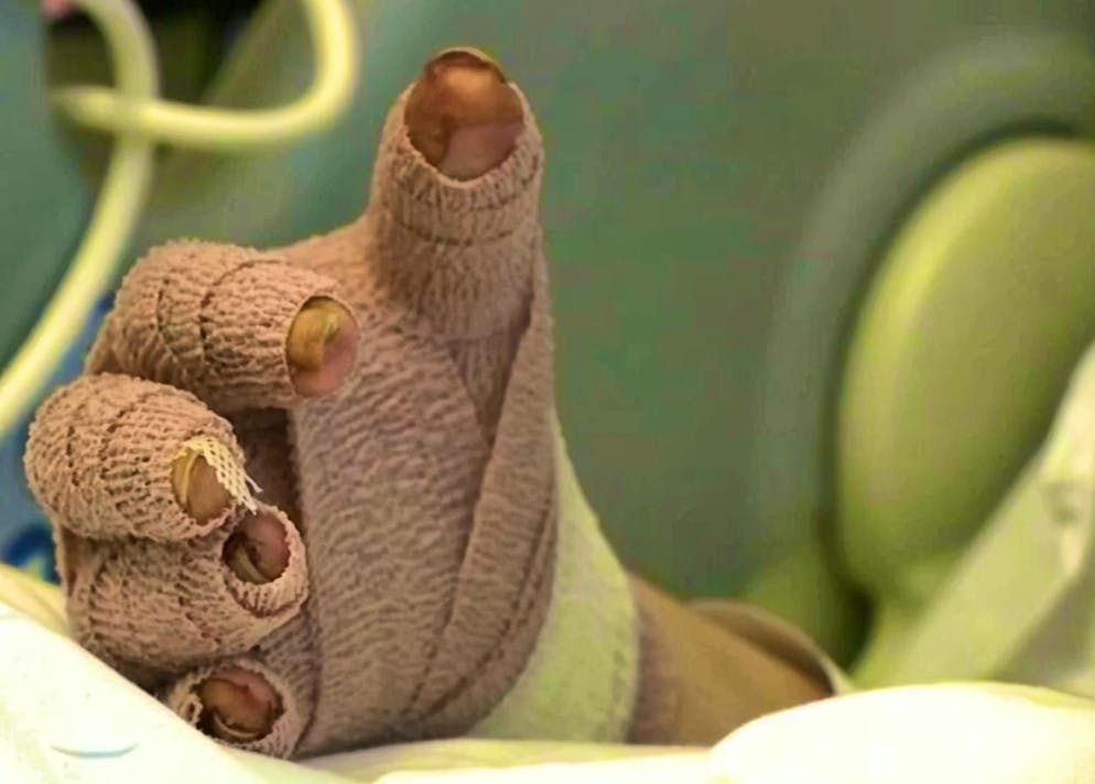 Rose needed several skin grafts. 