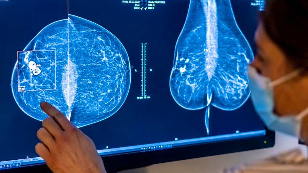 Viele Krebsfälle gehen auf vermeidbare Ursachen zurück. (Archivbild)