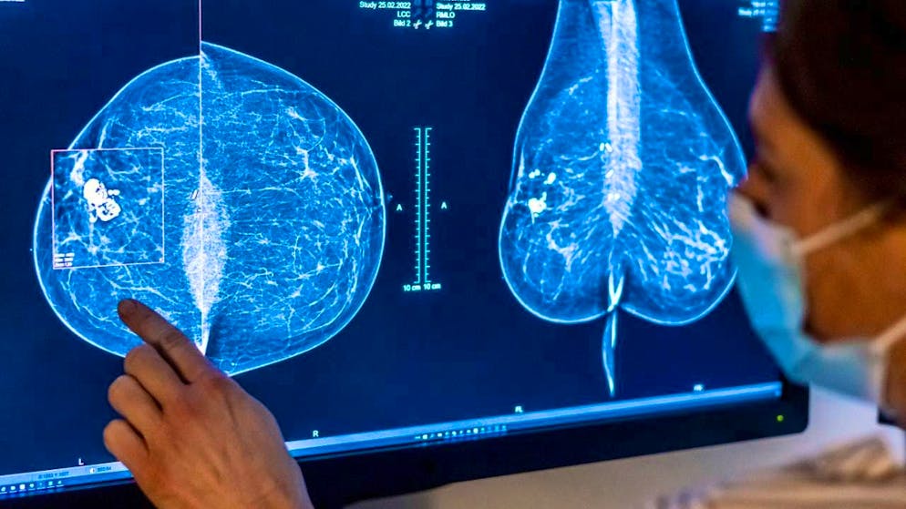 Many cancer cases are due to preventable causes. (archive image)