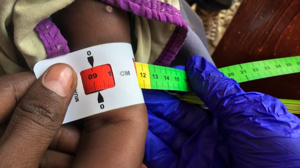 ARCHIV - Ein Arzt misst den Armumfang eines unterernährten Babys. Die rote Markierung bedeutet: Das Kind ist schwer unterernährt und braucht dringend Spezialnahrung. Foto: Eva-Maria Krafczyk/dpa