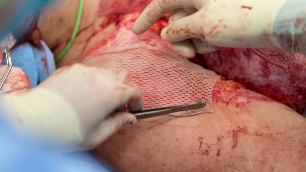 Schwere Verbrennungen verursachen bei Frauen fast doppelt so viele Blutinfektionen wie bei Männern. (Archivbild)