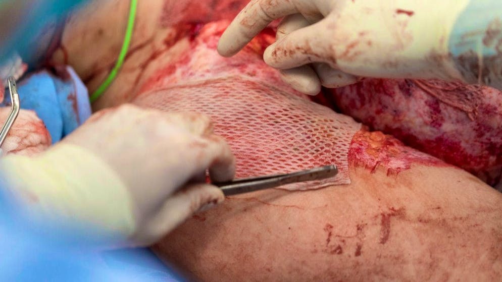 Severe burns cause almost twice as many blood infections in women as in men. (archive image)