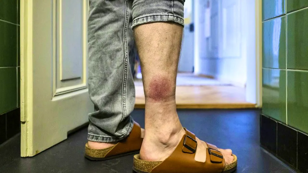 Suva recommends consulting a doctor after a tick bite if symptoms such as spreading redness, fever or headaches occur. (archive picture)