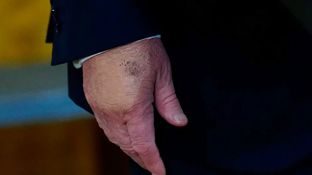 Depuis son retour à la Maison-Blanche en 2025, Donald Trump a été vu de temps à autre avec des hématomes sur la main droite, parfois maquillés (archives).
