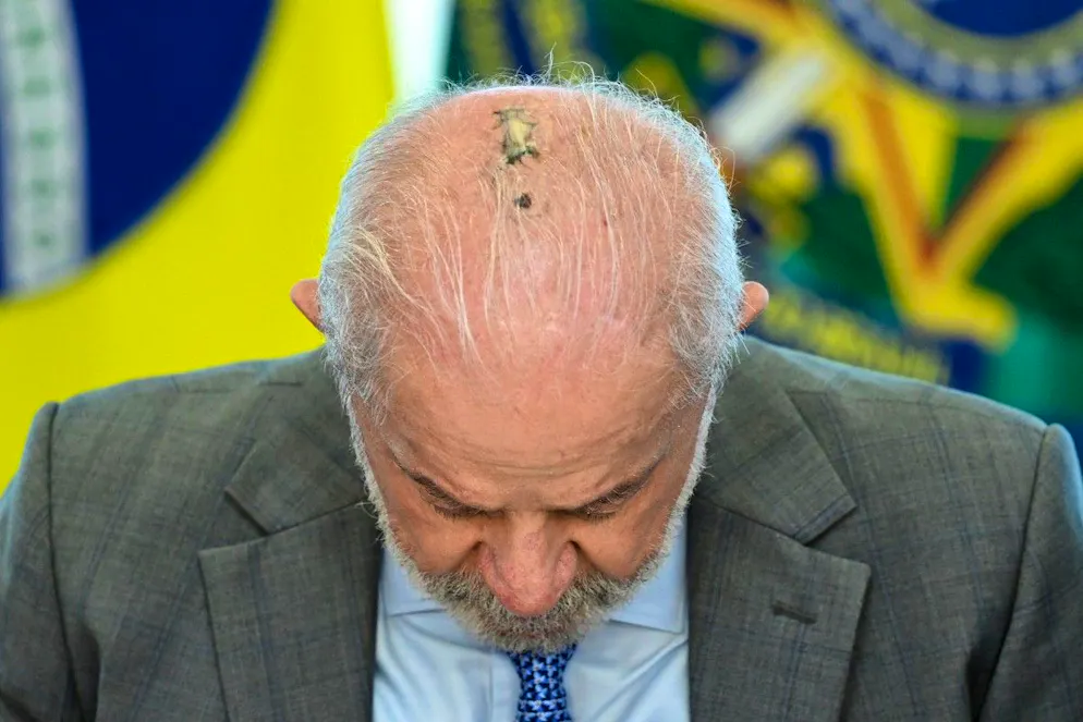 La lésion est bien visible sur le crâne du président brésilien.